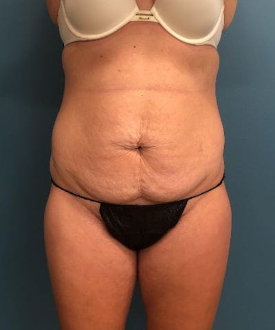 Tummy Tuck Before & After Gallery - Patient 243356 - Image 1