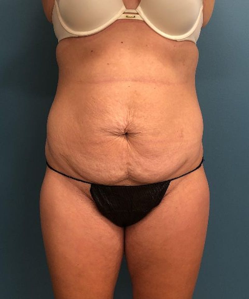 Tummy Tuck Before & After Gallery - Patient 243356 - Image 1