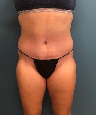 Tummy Tuck Before & After Gallery - Patient 243356 - Image 2