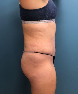 Tummy Tuck Before & After Gallery - Patient 243356 - Image 4