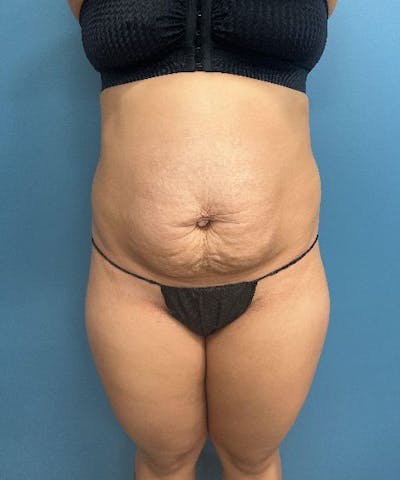 Tummy Tuck Before & After Gallery - Patient 848536 - Image 1