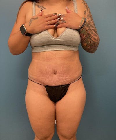 Tummy Tuck Before & After Gallery - Patient 848536 - Image 2