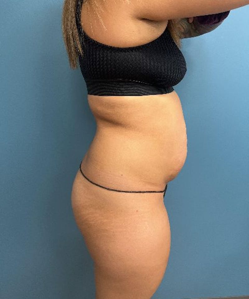 Tummy Tuck Before & After Gallery - Patient 848536 - Image 3