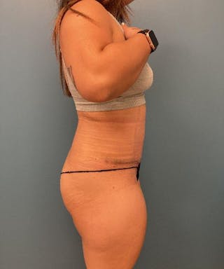 Tummy Tuck Before & After Gallery - Patient 848536 - Image 4