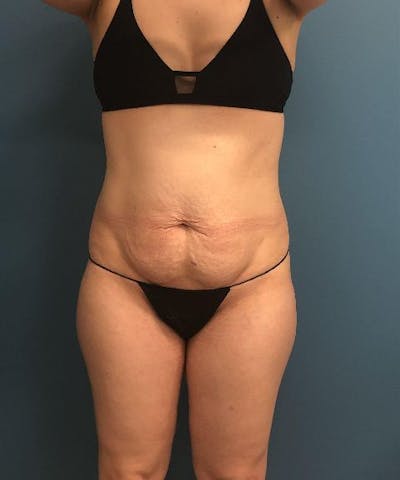 Tummy Tuck Before & After Gallery - Patient 229558 - Image 1
