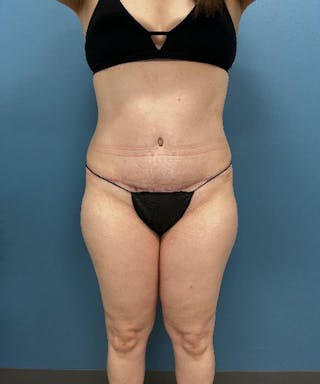 Tummy Tuck Before & After Gallery - Patient 229558 - Image 2
