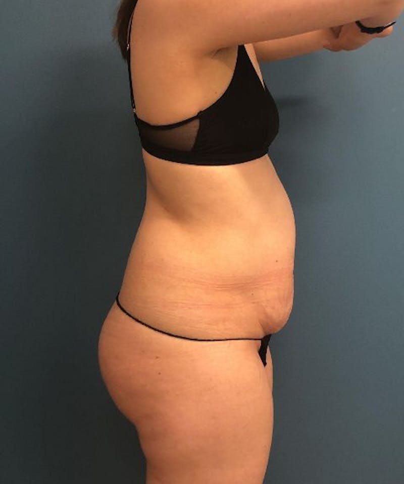 Tummy Tuck Before & After Gallery - Patient 229558 - Image 3