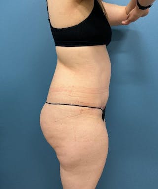 Tummy Tuck Before & After Gallery - Patient 229558 - Image 4