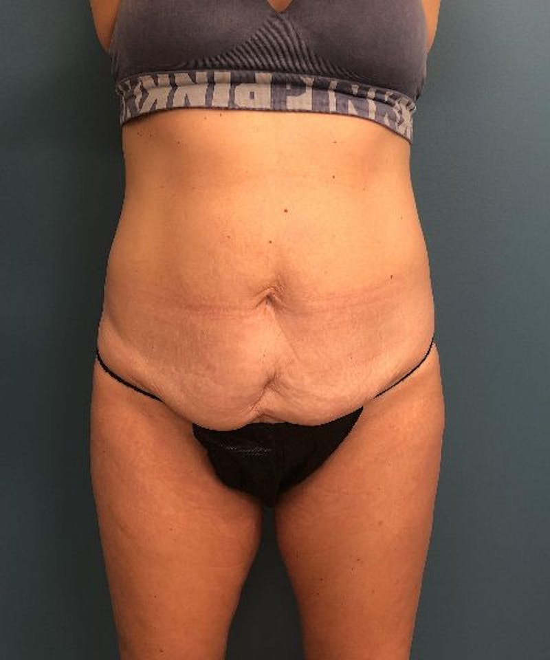 Tummy Tuck Before & After Gallery - Patient 245322 - Image 1