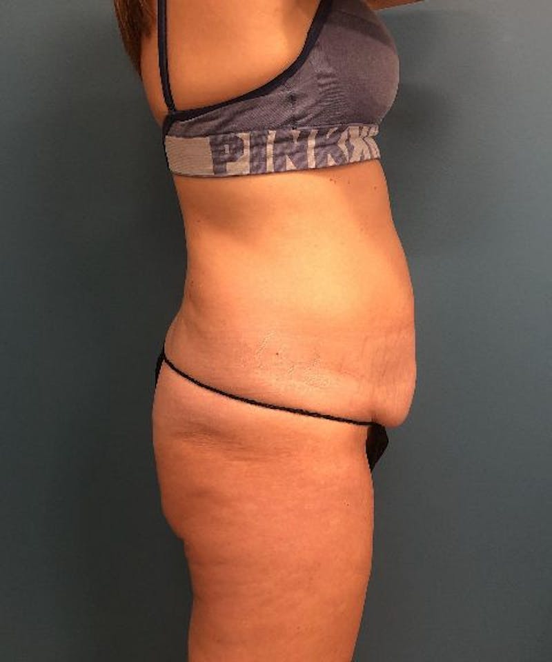 Tummy Tuck Before & After Gallery - Patient 245322 - Image 3