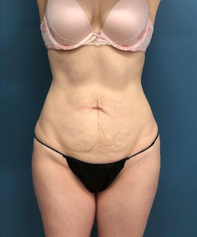 Tummy Tuck Before & After Gallery - Patient 197604 - Image 1