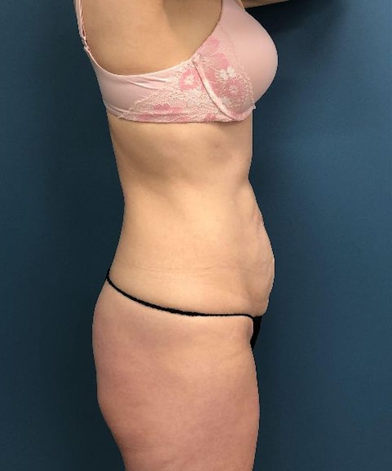 Tummy Tuck Before & After Gallery - Patient 197604 - Image 3