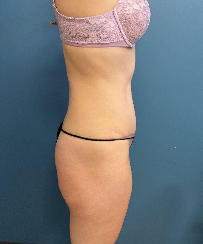 Tummy Tuck Before & After Gallery - Patient 197604 - Image 4