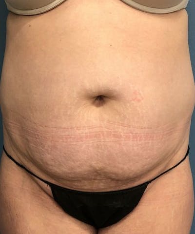 Tummy Tuck Before & After Gallery - Patient 394740 - Image 1