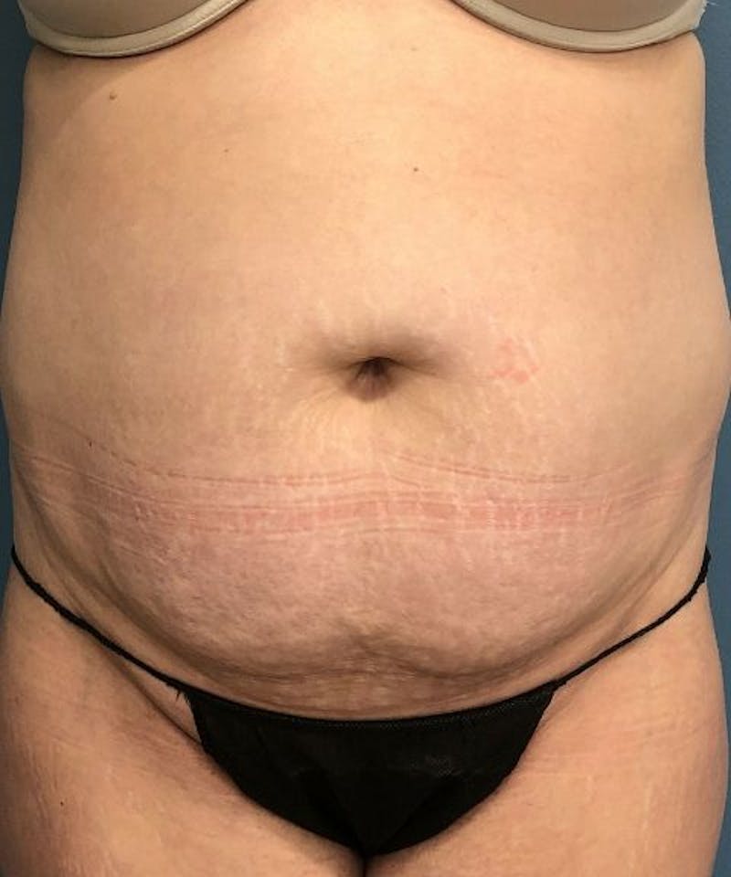 Tummy Tuck Before & After Gallery - Patient 394740 - Image 1