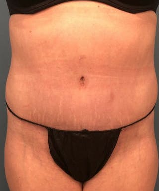 Tummy Tuck Before & After Gallery - Patient 394740 - Image 2