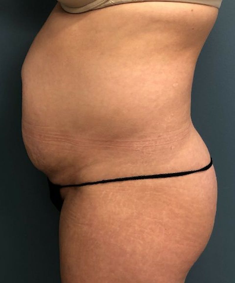 Tummy Tuck Before & After Gallery - Patient 394740 - Image 3