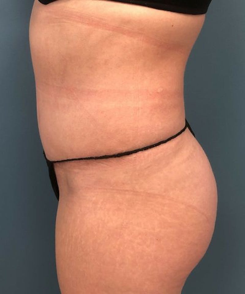Tummy Tuck Before & After Gallery - Patient 394740 - Image 4
