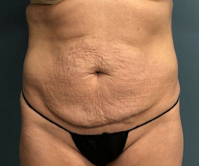 Tummy Tuck Before & After Gallery - Patient 140762 - Image 1