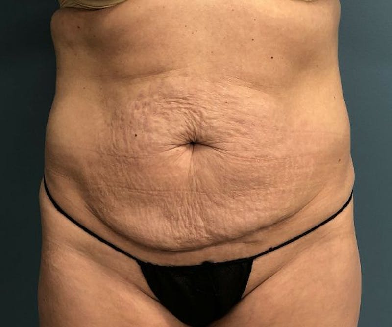 Tummy Tuck Before & After Gallery - Patient 140762 - Image 1