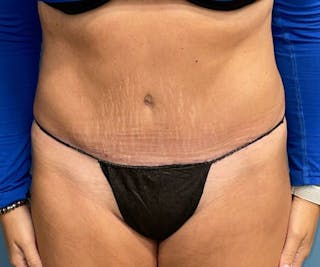 Tummy Tuck Before & After Gallery - Patient 140762 - Image 2