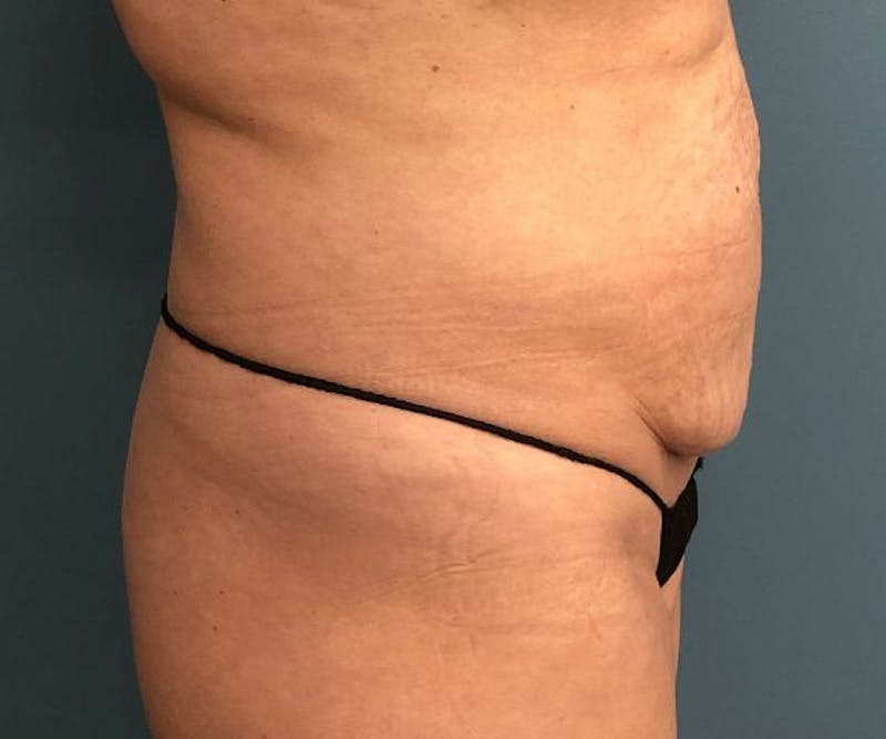 Tummy Tuck Before & After Gallery - Patient 140762 - Image 3