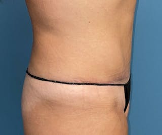 Tummy Tuck Before & After Gallery - Patient 140762 - Image 4