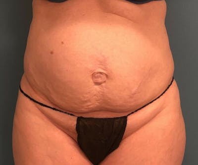 Tummy Tuck Before & After Gallery - Patient 118620 - Image 1
