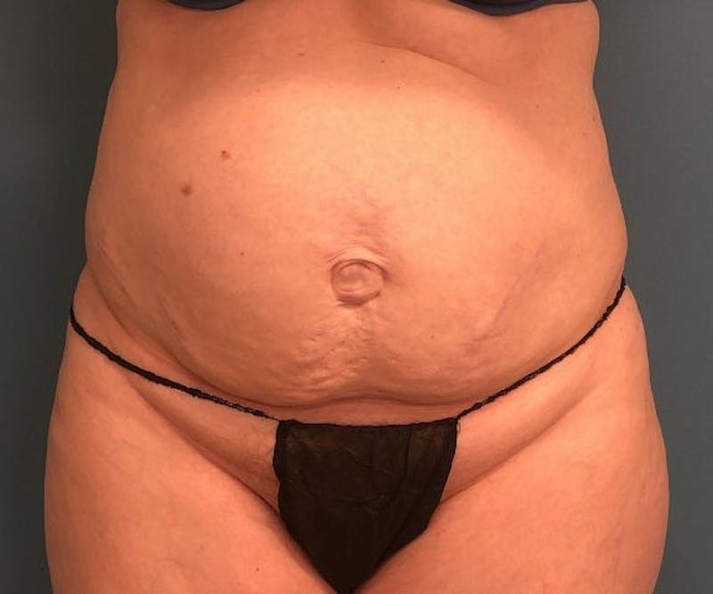 Tummy Tuck Before & After Gallery - Patient 118620 - Image 1