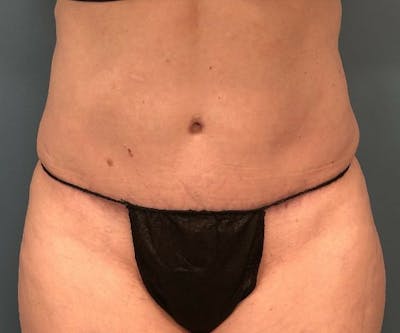 Tummy Tuck Before & After Gallery - Patient 118620 - Image 2