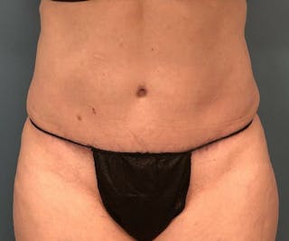 Tummy Tuck Before & After Gallery - Patient 118620 - Image 2