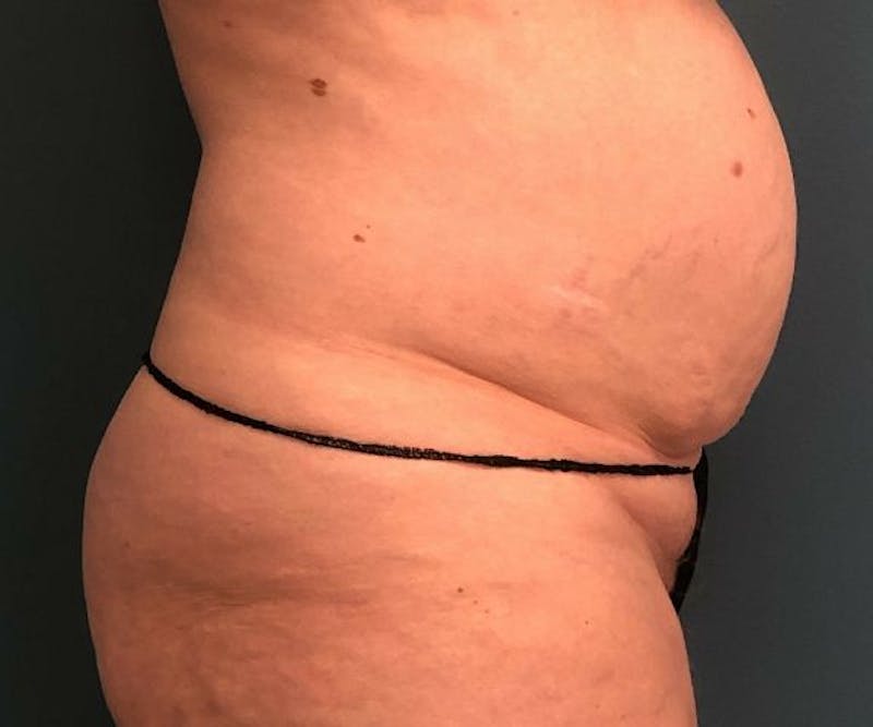 Tummy Tuck Before & After Gallery - Patient 118620 - Image 3