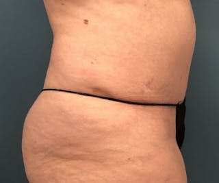 Tummy Tuck Before & After Gallery - Patient 118620 - Image 4