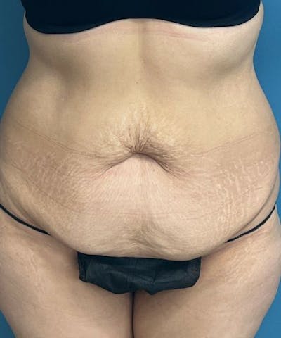 Tummy Tuck Before & After Gallery - Patient 427753 - Image 1