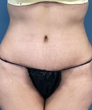 Tummy Tuck Before & After Gallery - Patient 427753 - Image 2