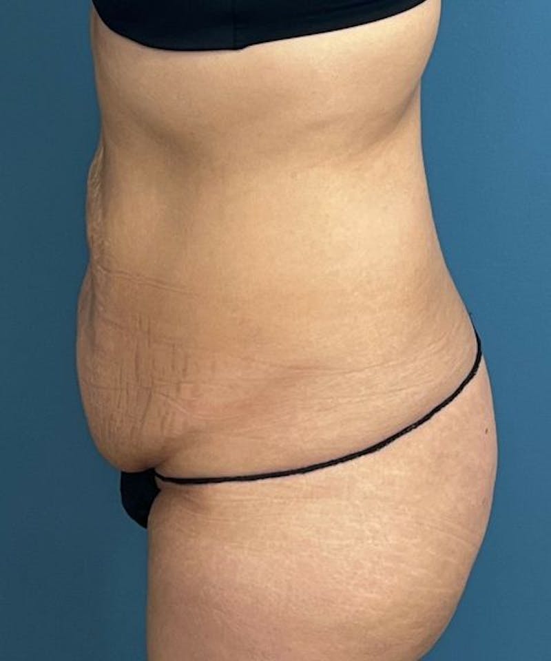 Tummy Tuck Before & After Gallery - Patient 427753 - Image 3