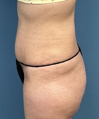 Tummy Tuck Before & After Gallery - Patient 427753 - Image 4