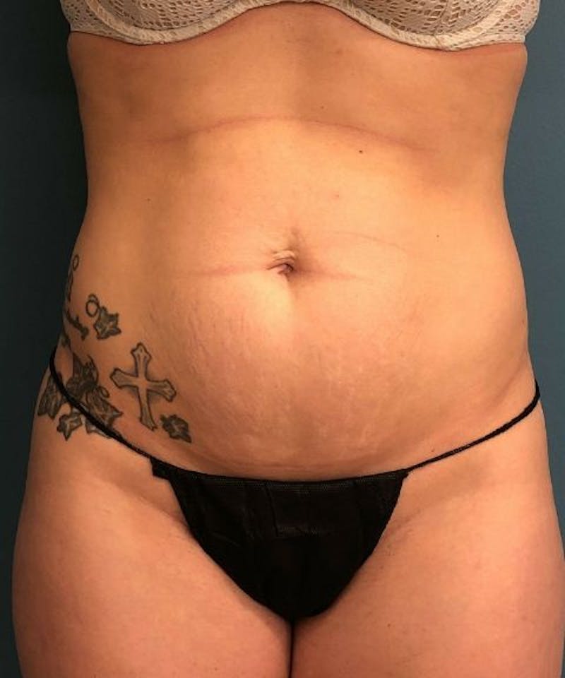 Tummy Tuck Before & After Gallery - Patient 280324 - Image 1