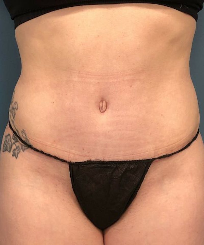 Tummy Tuck Before & After Gallery - Patient 280324 - Image 2