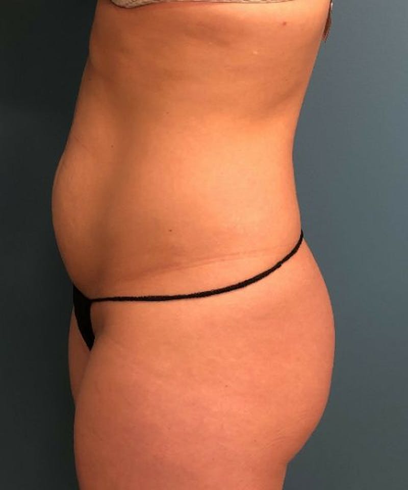 Tummy Tuck Before & After Gallery - Patient 280324 - Image 3