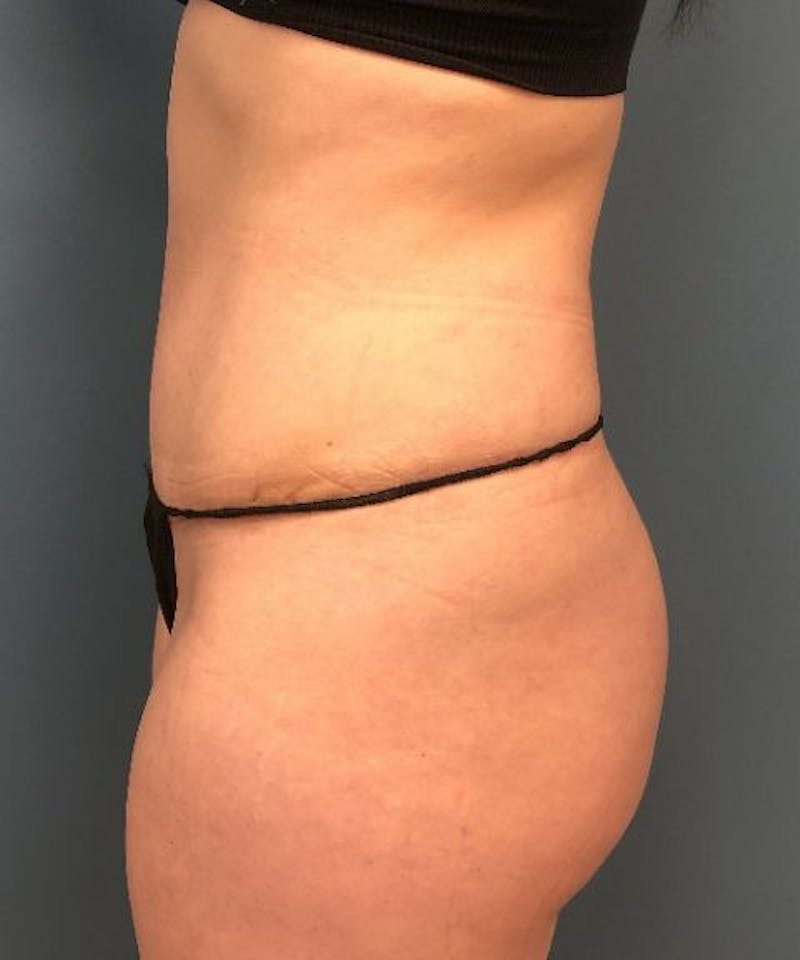 Tummy Tuck Before & After Gallery - Patient 280324 - Image 4