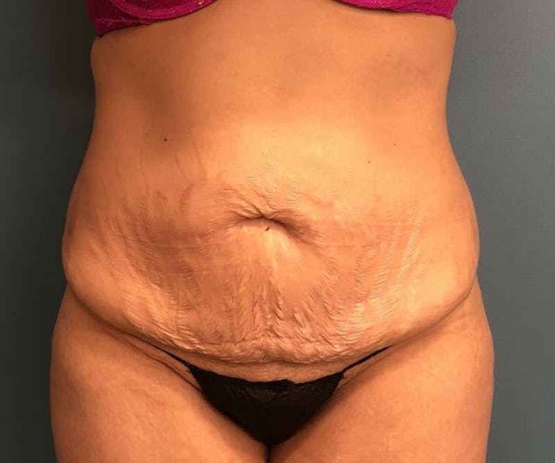 Tummy Tuck Before & After Gallery - Patient 362030 - Image 1
