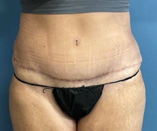 Tummy Tuck Before & After Gallery - Patient 362030 - Image 2