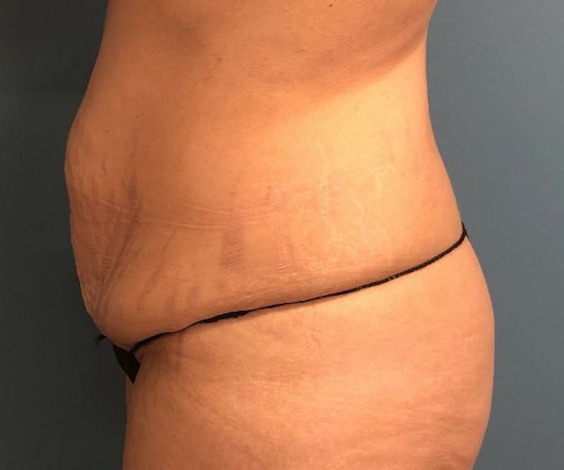 Tummy Tuck Before & After Gallery - Patient 362030 - Image 3