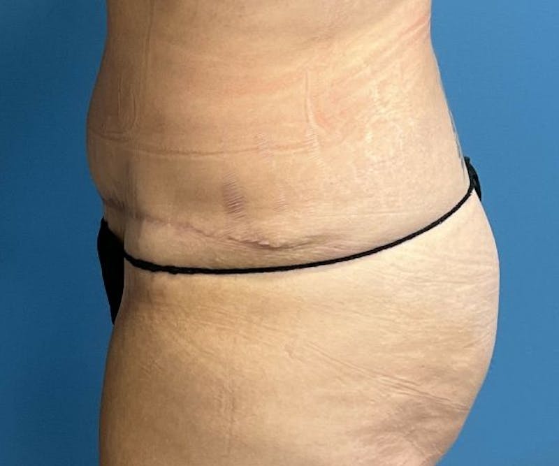 Tummy Tuck Before & After Gallery - Patient 362030 - Image 4
