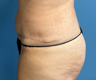 Tummy Tuck Before & After Gallery - Patient 362030 - Image 4
