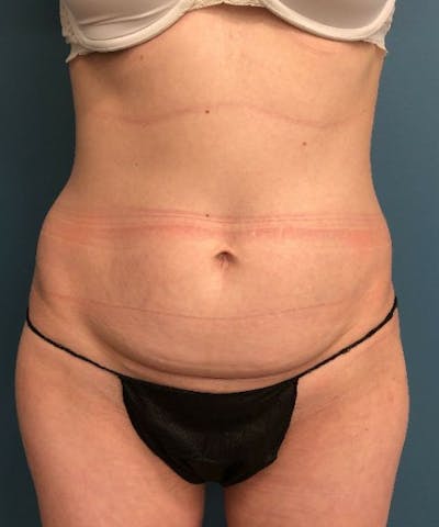 Tummy Tuck Before & After Gallery - Patient 416824 - Image 1
