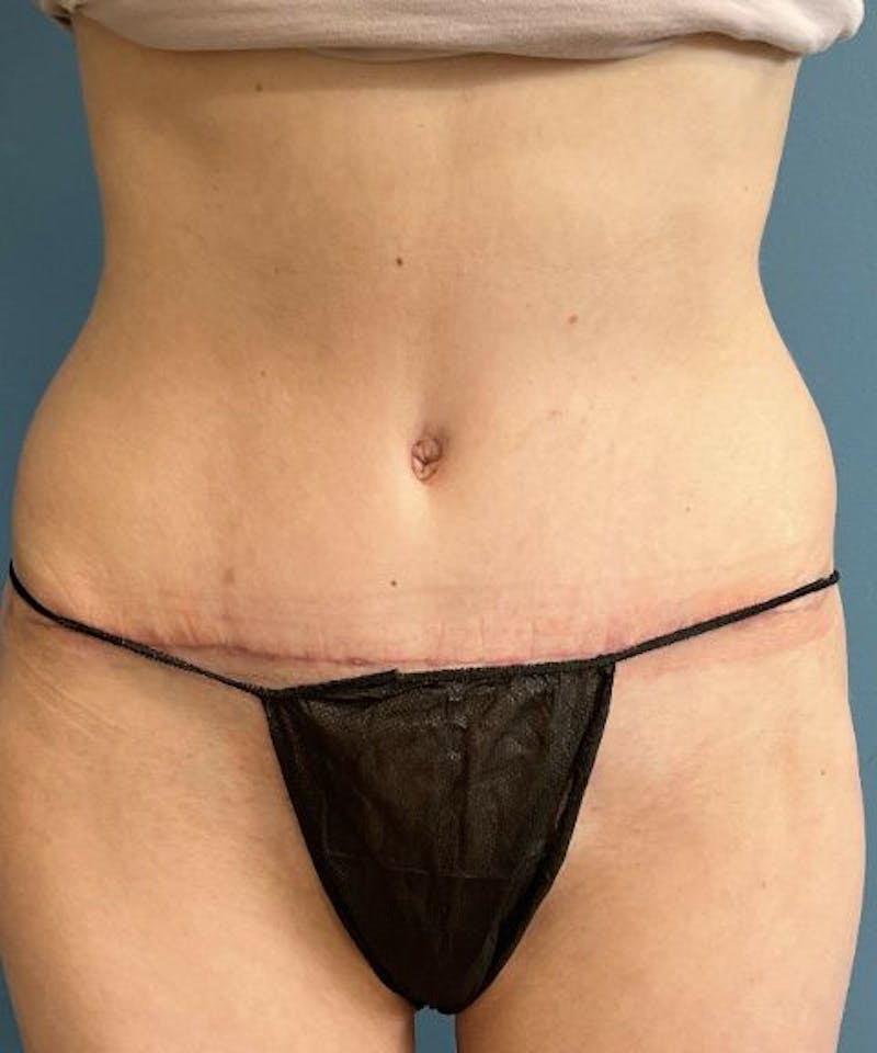 Tummy Tuck Before & After Gallery - Patient 416824 - Image 2