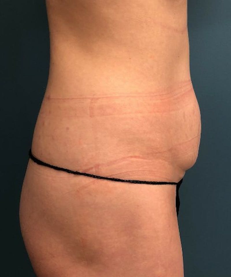 Tummy Tuck Before & After Gallery - Patient 416824 - Image 3