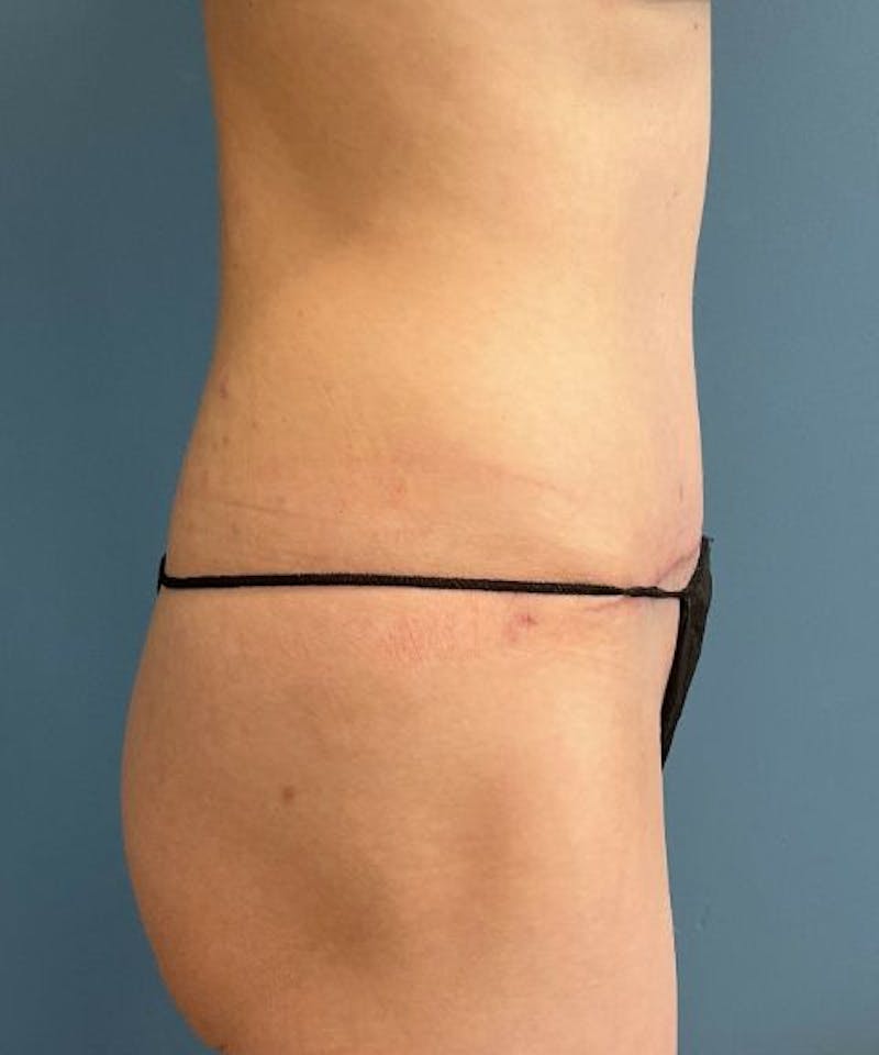 Tummy Tuck Before & After Gallery - Patient 416824 - Image 4
